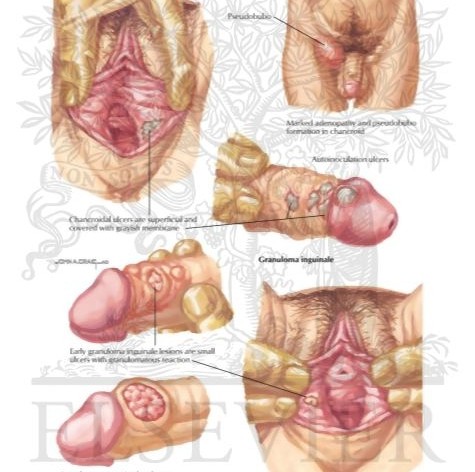 Hardin MD : STD Picture Gallery