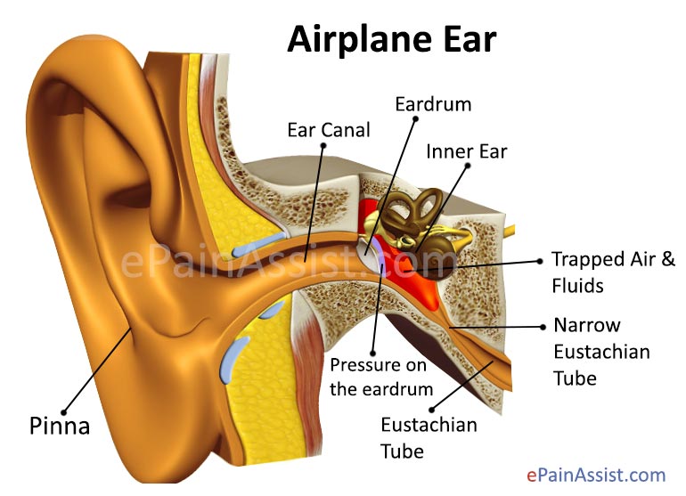 Airplane-ear